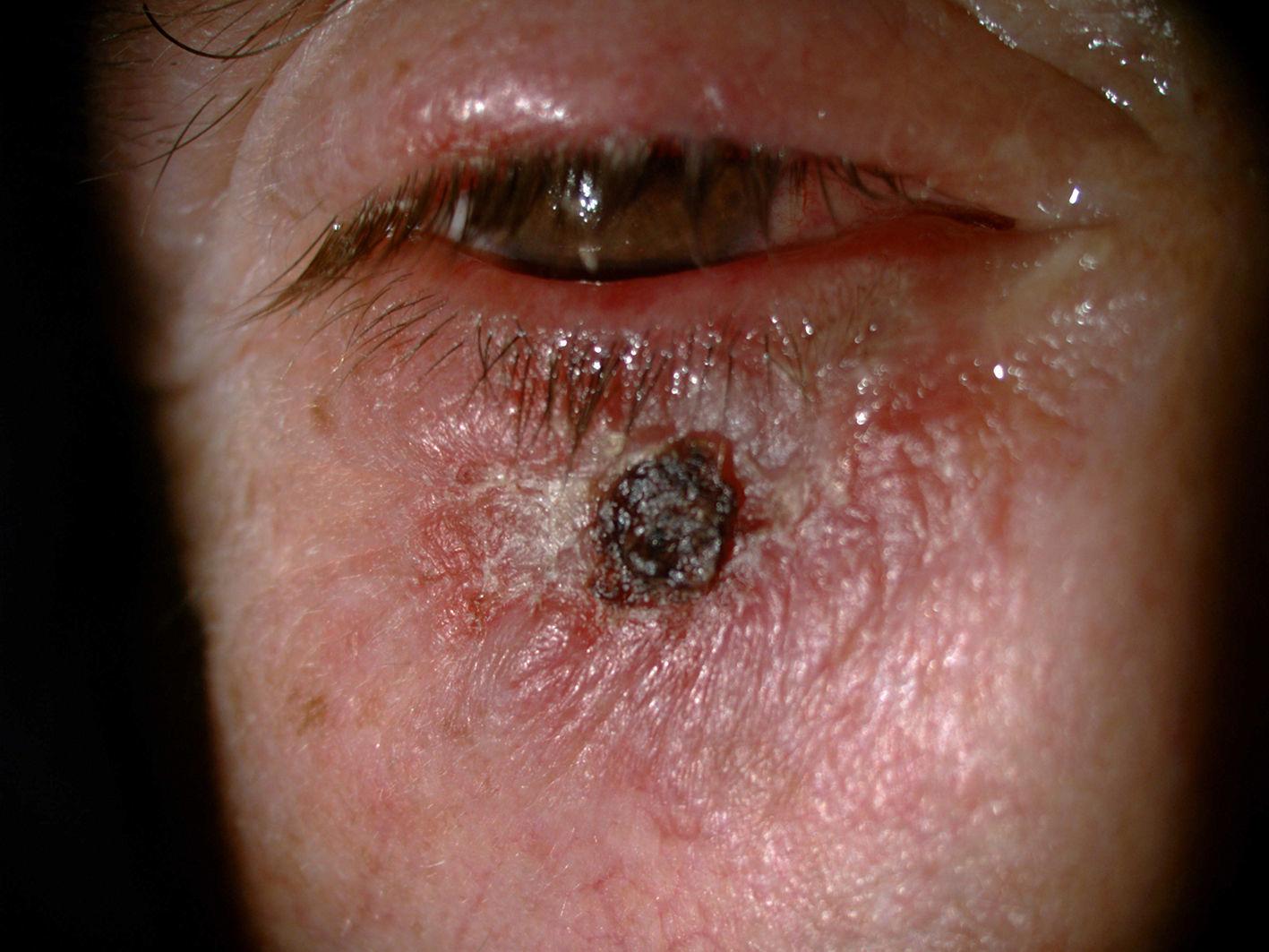 imiquimod crema al 5 costo