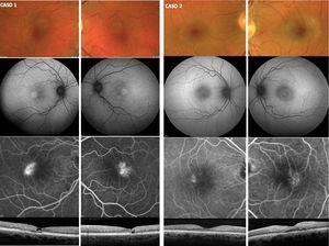 Presentación inicial de los 2pacientes en el momento del diagnóstico de telangectasia macular idiopática tipo 2 (MacTel 2). Se muestran la retinografía, la autofluorescencia, la angiografía fluoresceínica y la OCT con los signos típicos de MacTel 2. Nótese la gran asimetría en el caso 2, donde el OD presenta signos sutiles de MacTel 2 en comparación con el OI.