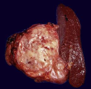 Neoplasia neuroendocrina de cola de páncreas, bien circunscrita, de color café claro, de 6cm en diámetro mayor.