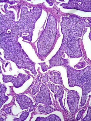Neoplasia neuroendocrina bien diferenciada de estómago con patrón de crecimiento insular.