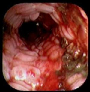 The image shows the presence of tissue embedment along the covered portion of the PSEMS.