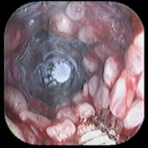After removal of the stent, the image shows total destruction of the covered portion.