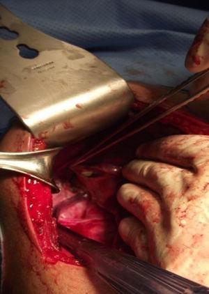El hígado reclinado por la mano hacia la izquierda de la paciente. Se hace aparente la capa blanquecina de la membrana germinativa.