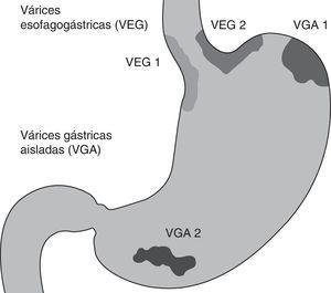 Clasificación de las várices gástricas. Clasificación descrita por Sarin, las VEG tipo 1 son continuación de las várices esofágicas extendiéndose hasta 5cm debajo de la unión esofagogástrica a lo largo de la curvatura menor del estómago, las VEG tipo 2 se extienden por debajo de la unión esofagogástrica hacia el fondo gástrico. Las VGA se dividen en VGA tipo 1, localizadas en el fondo, y VGA tipo 2, localizadas en cualquier otra parte del estómago. VGA: várices gástricas aisladas; VEG: várices esofagogástricas.