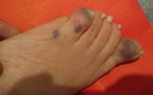Lesiones redondeadas azuladas, que deforman un pie.