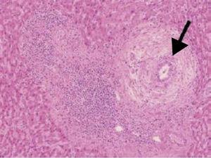 Fibrosis periductular severa característica de CEP «cáscara de cebolla».