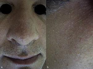 Imagen clínica que muestra múltiples pápulas firmes, cupuliformes, de superficie lisa y coloración piel normal en el dorso nasal (a) y en la región de la mejilla derecha (b), indicativas de fibrofoliculomas.