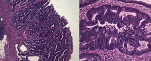 Fotomicrografías con tinción en hematoxilina-eosina que muestran un adenoma tubulovelloso con focos de displasia de alto grado.