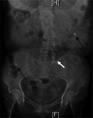 Radiografía de abdomen con distensión gástrica, dilatación de asas intestinales (flecha blanca) y cálculos biliares ectópicos (flechas negras punteadas).