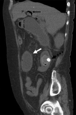 Corte sagital de tomografía abdominal con tríada de Rigler. Dilatación de asas intestinales (flecha blanca), neumobilia (flecha negra) y cálculo biliar ectópico en yeyuno proximal (flecha negra punteada).