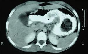 Tomografía axial computarizada con doble contraste, donde se observa la presencia de un tumor intragástrico, con espirales de densidades variables, alternando con aire y paso parcial del medio de contraste hidrosoluble.