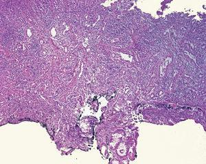 Caso 6. Laminilla de la neoplasia teñida con hematoxilina y eosina, por debajo de la mucosa esofágica; se observa proliferación fusocelular, vasos prominentes y abundante infiltrado inflamatorio por eosinófilos y linfocitos.