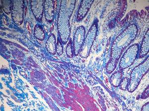 Fotomicrografía a mediano aumento de pólipo hamartomatoso: glándulas distorsionadas separadas por bandas de tejido muscular de la muscular de la mucosa (tricrómico de Masson).