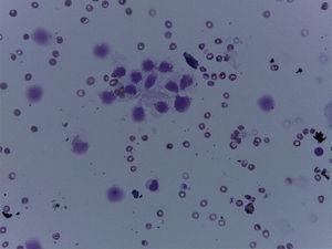 Imagen de citología obtenida por PAAF de una de las lesiones quísticas que mostró células epiteliales cuboideas ricas en glucógeno compatibles con el diagnóstico de cistoadenoma seroso (tinción hematoxilina-eoxina).