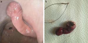 a-b) Pólipo fibroide inflamatorio: a) antes (aspecto endoscópico), y b) después (pieza macroscópica) de la polipectomía.