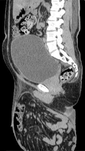 La imagen tomográfica abdominal en corte sagital muestra vejiga llena y asas de intestino delgado en gran saco herniario extraabdominal.