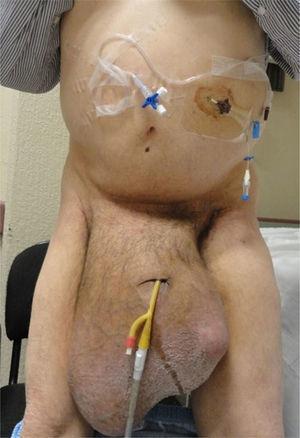 Paciente en bipedestación, con sonda de Foley y catéter de Tenckhoff colocado en cuadrante superior izquierdo mediante aguja de Veress, para insuflación de la cavidad abdominal.
