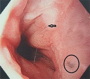 Unión esófago-gástrica con lesión única melanótica de bordes irregulares.