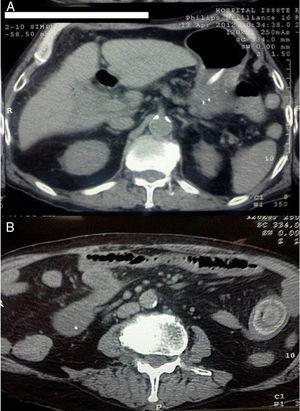 A) Tomografía simple de abdomen corte axial (paciente n.° 1 con obstrucción intestinal) vesícula biliar no visible y pneumobilia. B) Corte axial inferior que muestra lito intraluminal calcificado.