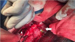 Imagen intraoperatoria de paciente n.° 3. Se observa vesícula biliar escleroatrófica, con apertura en su fondo, donde se encuentran restos de trayecto fistuloso pequeño (flecha menor), duodeno con edema importante y apertura y restos de tejido de trayecto fistuloso (flecha mayor).