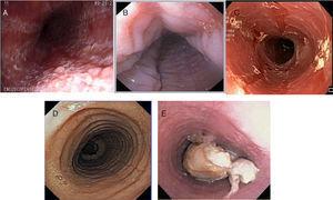 Fenotipo inflamatorio (A: moteado blanquecino; B: surcos longitudinales; C: edema mucosa [papel crepé]) y fenotipo fibroestenótico (D: anillos; E: estenosis con impactación alimentaria) de la esofagitis eosinofílica por endoscopia.