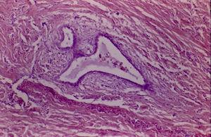 Fotomicrografía mediano aumento (H&E), con glándulas endometriales entre las fibras musculares de la pared del apéndice.