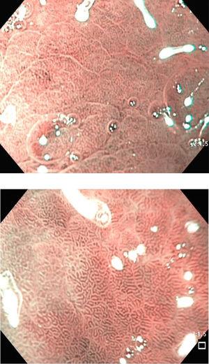 Morfología epitelial de mucosa no metaplásica con criptas ovaladas regulares en la endoscopia NBI (1.5× zoom electrónico).