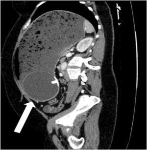 Imagen de TC sagital oblicua en la que se observa el balón intragástrico enclavado en el antro del estómago y la gran dilatación de todo el estómago.