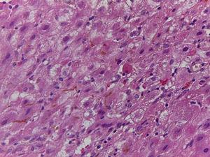 Biopsia de hígado con hematoxilina-eosina. Lobanillo hepático. Hepatocitos apoptósicos y cambios regenerativos.