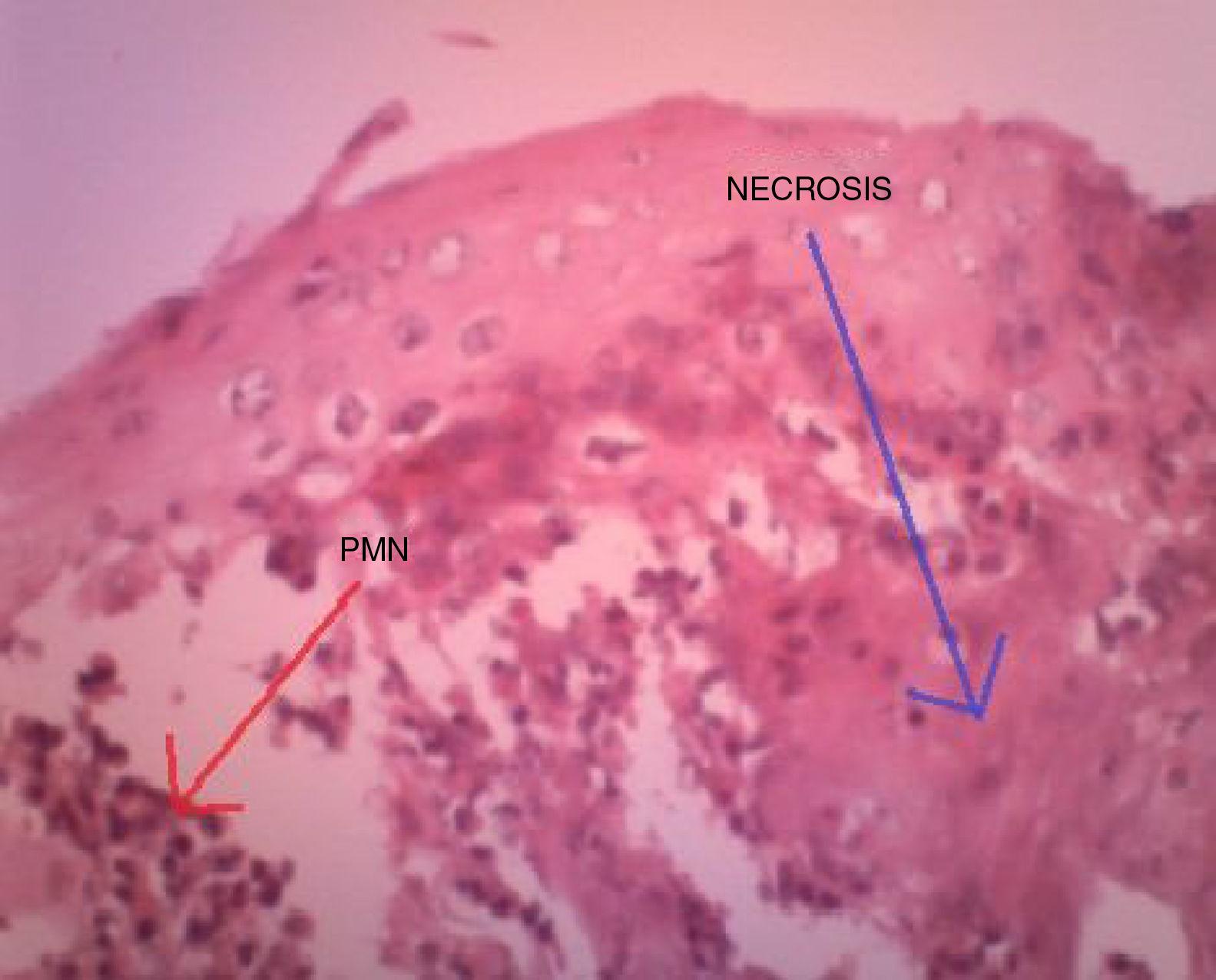 Esofagitis severa por bromuro de pinaverio | Revista de Gastroenterología  de México