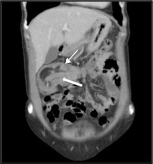 TAC abdominal en corte coronal: invaginación del íleon (flecha gruesa) en el colon transverso (flecha delgada). «Signo de la salchicha».