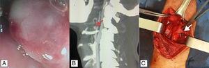 A)Endoscopia: lesión pulsátil en hipofaringe. B)Angiotomografía cervical: se observa probable variación anatómica de la arteria lingual (flecha roja). C)Imagen transoperatoria del tronco tirolingual (flecha blanca).
