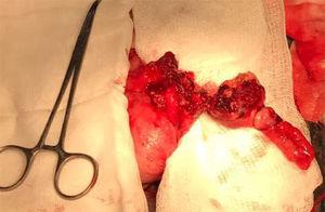 Tumor apendicular con infiltración a ciego.