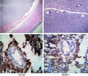 Cortes histológicos de lesión neoplásica de apéndice formada por linfocitos neoplásicos (H&E e inmunohistoquímica).