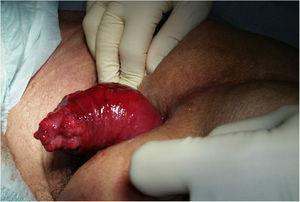 Prolapso rectal completo con un neoplasma polipoide irregular en el extremo distal.