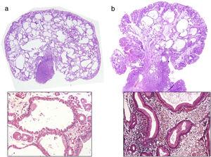 Características microscópicas de pólipos gástricos pedunculados. Se observa dilatación quística de glándulas y expansión foveolar en ambos pólipos, pero la inflamación es abundante en el pólipo hiperplásico (a). La cobertura de células principales y parietales en la glándula dilatada es la marca distintiva de los pólipos de glándulas fúndicas (b). Tinción hematoxilina-eosina, ×20 y ×400.
