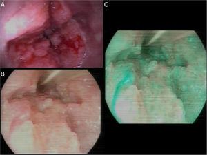 A) Hallazgos endoscópicos al diagnóstico, neoformación estenosante. B) Detalle de la superficie mucosa de aspecto papilomatoso. C) Detalle de la superficie mucosa visto con cromoendoscopia virtual, I-Scan 3.