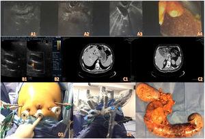 A1-A4) Imágenes de ultrasonido endoscópico. B1-B2) Ultrasonido abdominal. C1-C2) Tomografía de abdomen contrastada. D1-D2) Posicionamiento de trocares y docking del robot. E) Pieza quirúrgica.