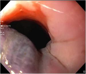 Endoscopía digestiva alta mostrando masa lineal violácea que ocupa parcialmente la luz esofágica en la unión gastroesofágica.