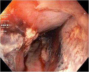 Endoscopía digestiva alta mostrando disección y pequeño desgarro de la mucosa con restos hemáticos en tercio medio del esófago.