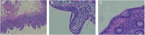 A) Aumento ×5 de corte duodenal mostrando atrofia vellositaria compatible con Marsh 3a. B) Aumento ×20 de corte duodenal mostrando linfocitosis intraepitelial. C) Aumento ×30 de corte de colon mostrando linfocitosis intraepitelial.
