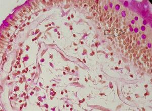 Biopsia de la segunda parte del duodeno teñida con H&E y PAS ×20, que muestra macrófagos infiltrando la lámina propia.