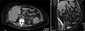 Tomografía computarizada no contrastada de abdomen, corte axial y coronal. Se demuestra lito intravesicular.