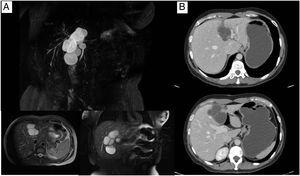 Resonancia magnética (A) y tomografía axial (B) donde se evidenció la lesión sugerente de cistoadenoma biliar en segmento 4 hepático.
