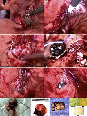 Resección de lesiones subepiteliales cardiales empleando cirugía láparo-endoscópica transgástrica, intraluminal A) Lesiones extraídas e inmunohistoquímica B).