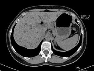 Tomografía axial computarizada: Múltiples pequeñas lesiones hepáticas de baja atenuación en corte transversal de abdomen superior.