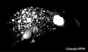 Colangiopancreatografía por resonancia magnética: Múltiples pequeñas lesiones dispersas uniformemente en ambos lóbulos hepáticos en forma de «cielo estrellado».