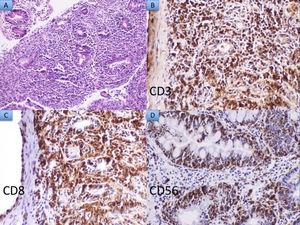 A) Hematoxilina y eosina ×20: Infiltrado linfoide denso constituido por células linfoides monomorfas de tamaño intermedio. B-D) Las células neoplásicas expresan los marcadores CD3, CD8 y CD56, respectivamente.