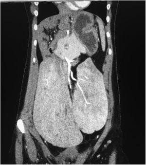 Tomografía abdominopélvica en fase arterial contrastada. Corte coronal que muestra localización pélvica de la glándula hepática con presencia de lóbulo de Riedel.