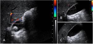 Signos de colecistitis aguda en ultrasonido. A) Vascularidad aumentada en vesícula biliar. B) Engrosamiento de pared. C) Colelitiasis.